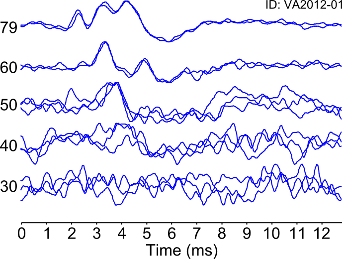 Auditory brainstem response